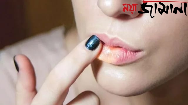 গরমে ঠোঁট ফাটলে কী করবেন